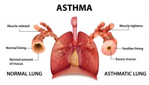 asthma infographic comparison